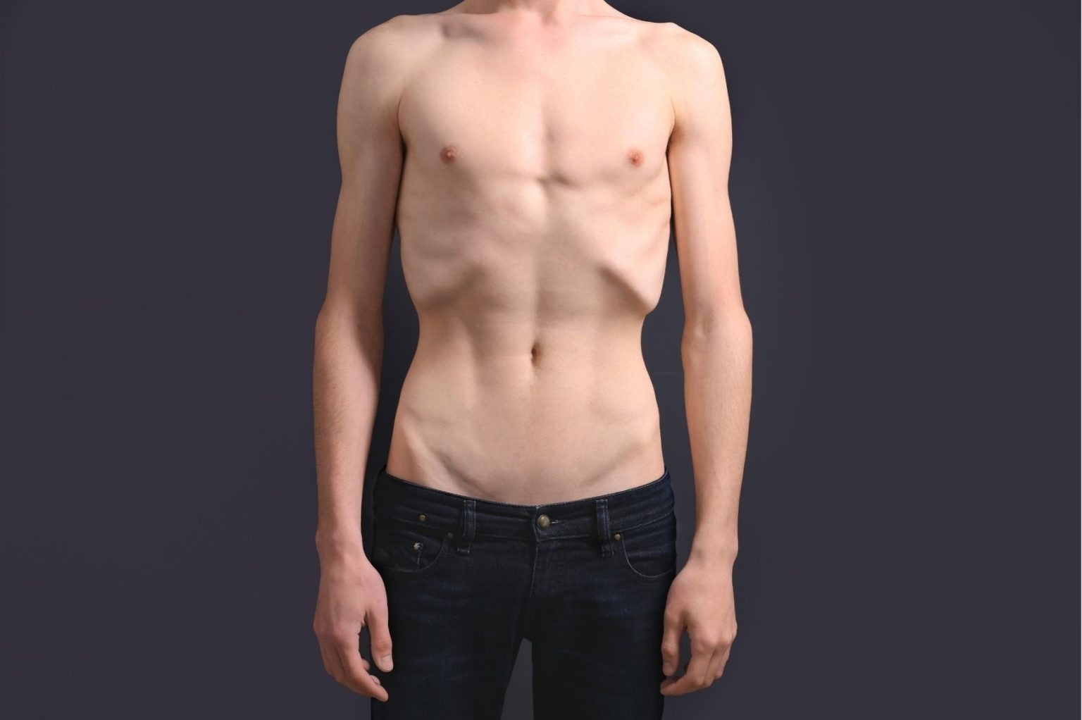 Diferencias entre anorexia y bulimia - PsiquiatrasOnline.com